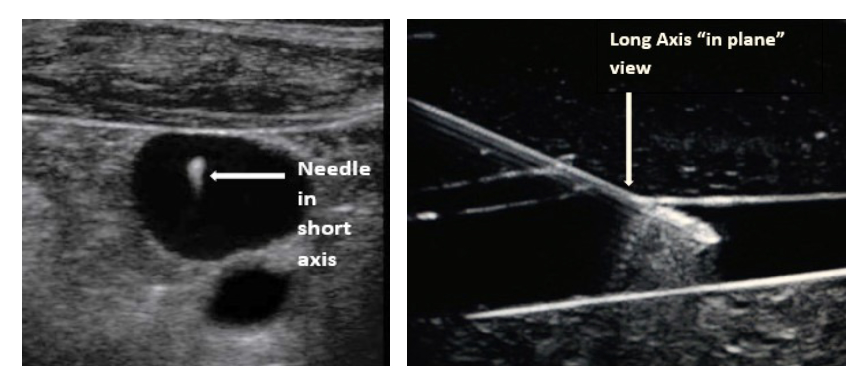 The benefits of Ultrasound Guidance when used to aid in central venous, peripheral venous, or arterial access.